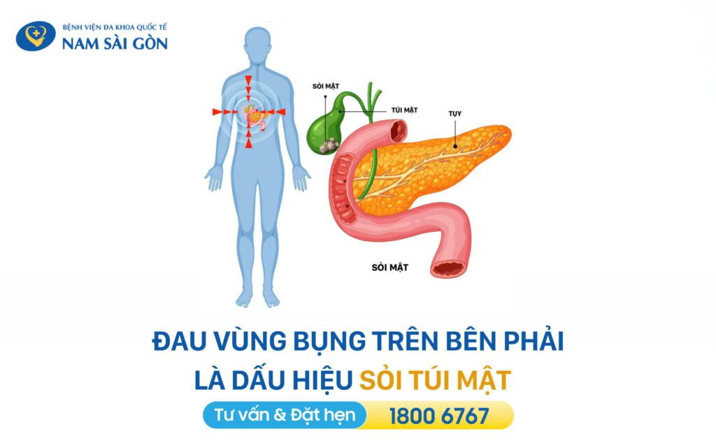 dấu hiệu sỏi túi mật