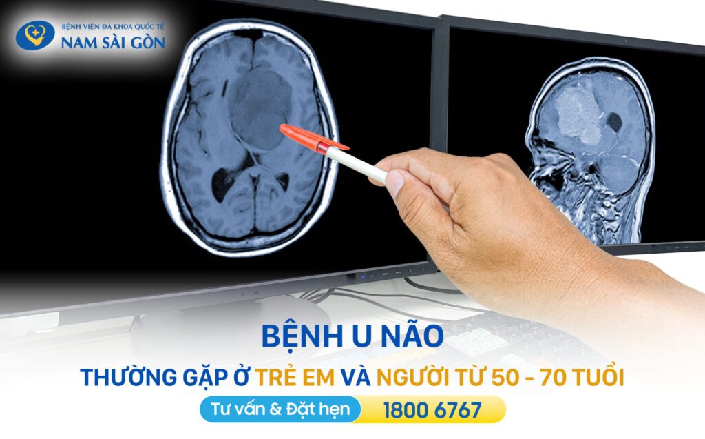 u não nguyên nhân và cách điều trị