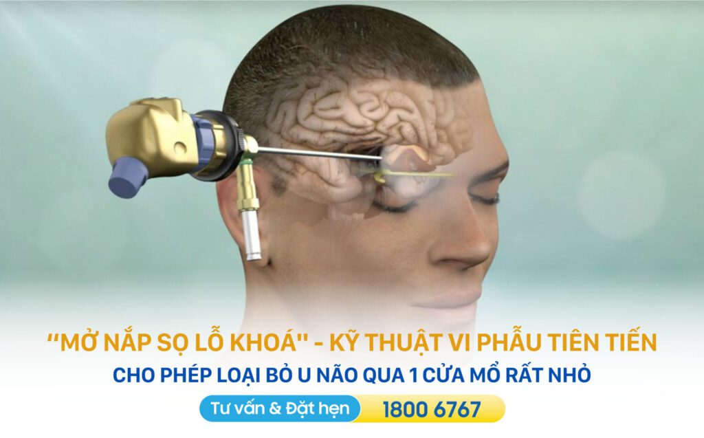 phẫu thuật trị u não