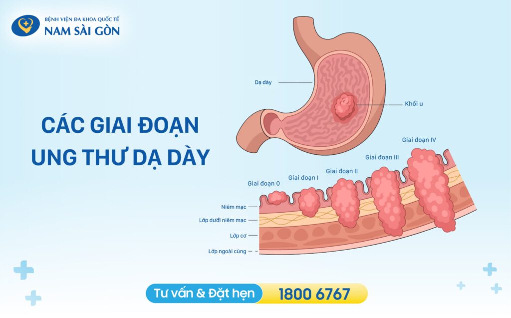 Các giai đoạn của bệnh ung thư dạ dày