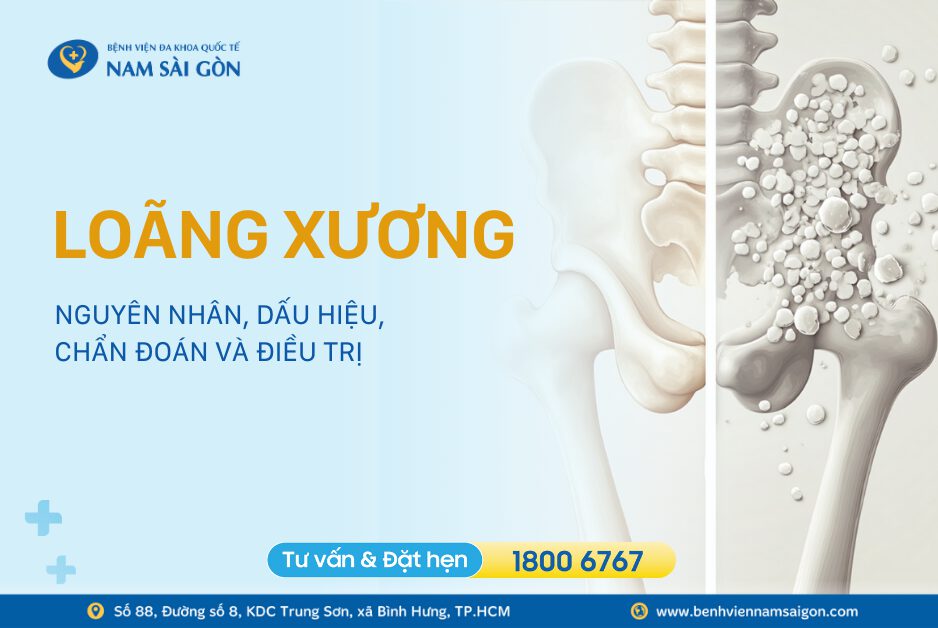 LOÃNG XƯƠNG – NGUYÊN NHÂN, DẤU HIỆU, CHẨN ĐOÁN VÀ ĐIỀU TRỊ