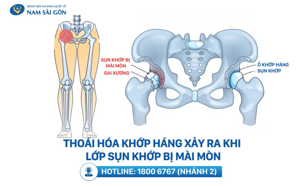 thoai hoa khop hang la gì
