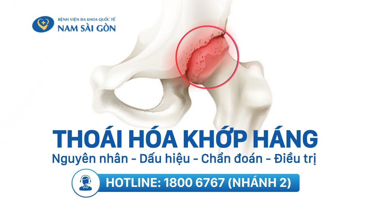 THOÁI HÓA KHỚP HÁNG – NGUYÊN NHÂN, DẤU HIỆU, CHUẨN ĐOÁN, ĐIỀU TRỊ