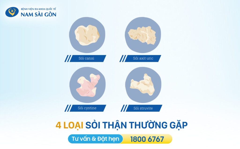 bệnh sỏi thận các loại sỏi thận phổ biến