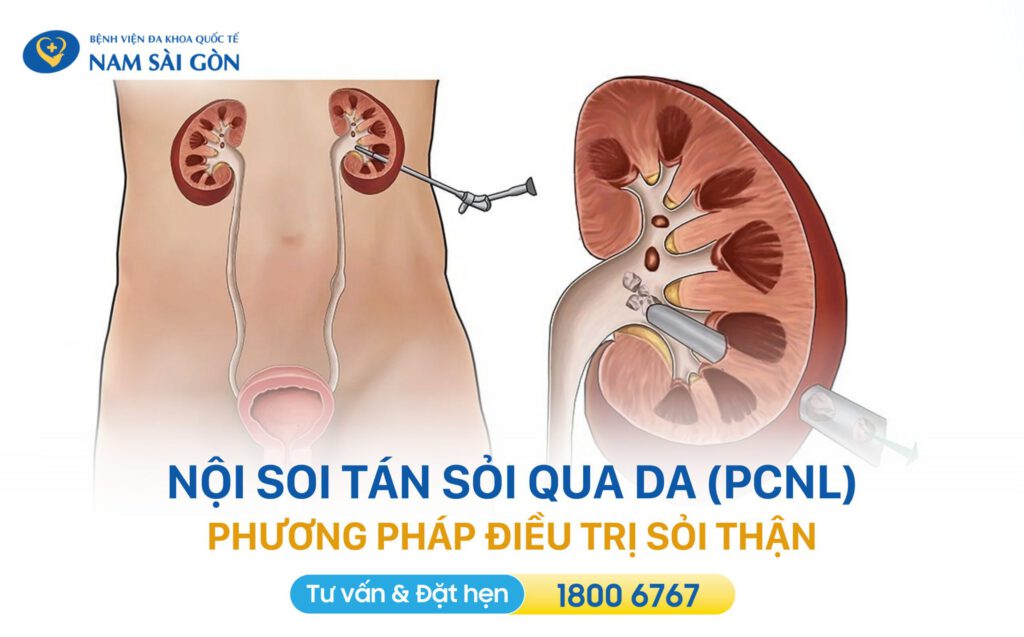 tại sao lại bị sỏi thận nội soi tán sỏi thận qua da