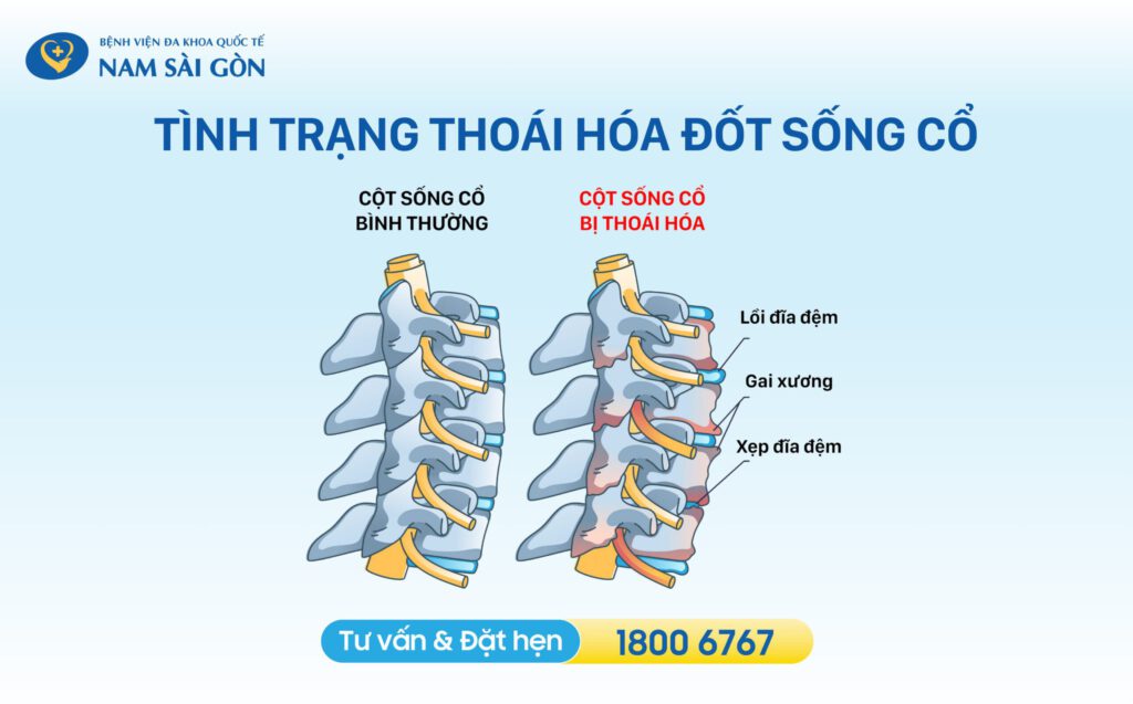 THOÁI HÓA ĐỐT SỐNG CỔ - NGUYÊN NHÂN VÀ CÁCH ĐIỀU TRỊ HIỆU QUẢ 3 cột sống cổ khi bị thoái hóa