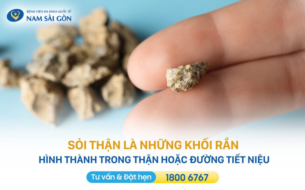 sỏi thận là gì sỏi thận - khối rắn hình thành trong thận và đường tiết niệu
