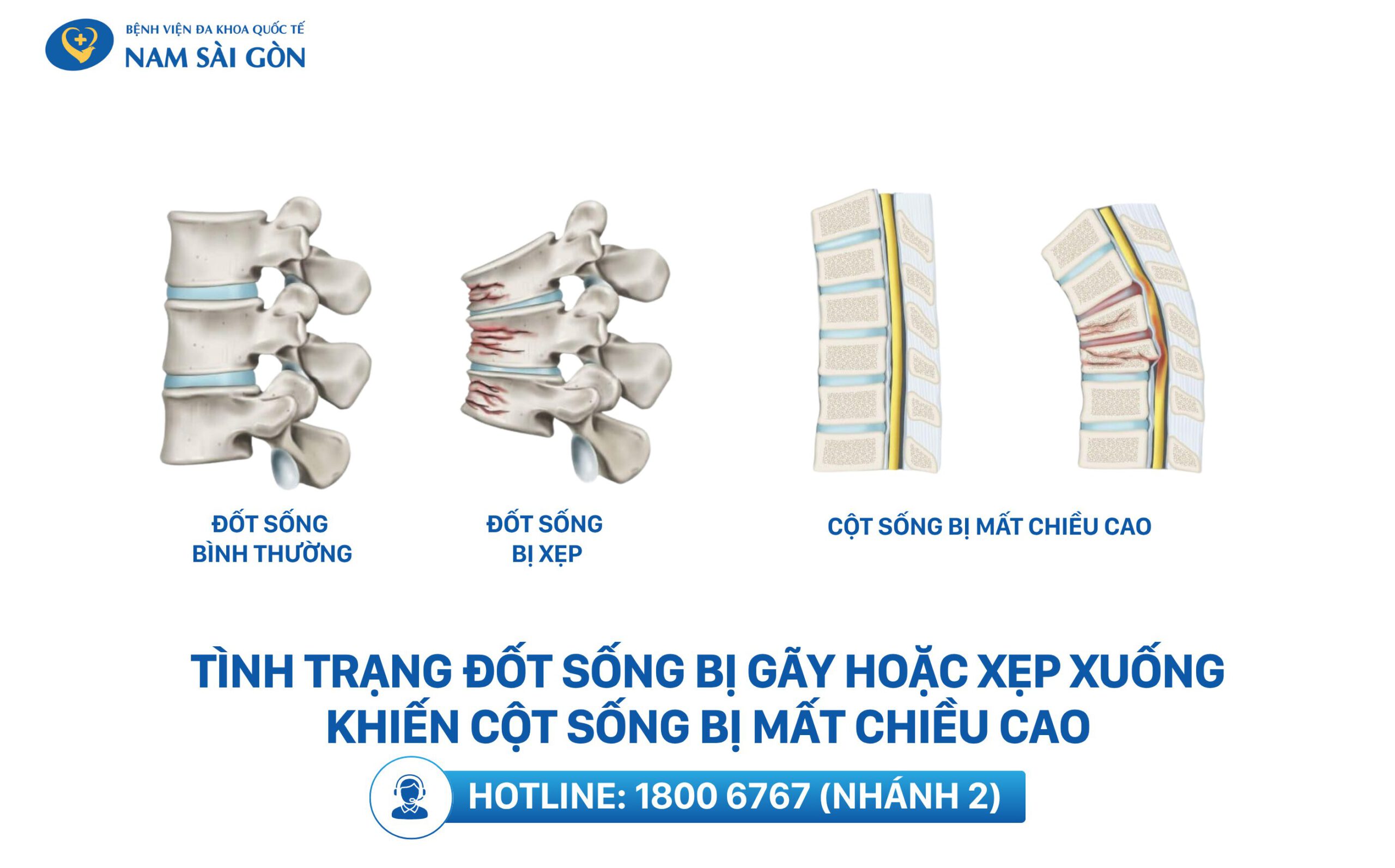 xẹp đốt sống là gì
