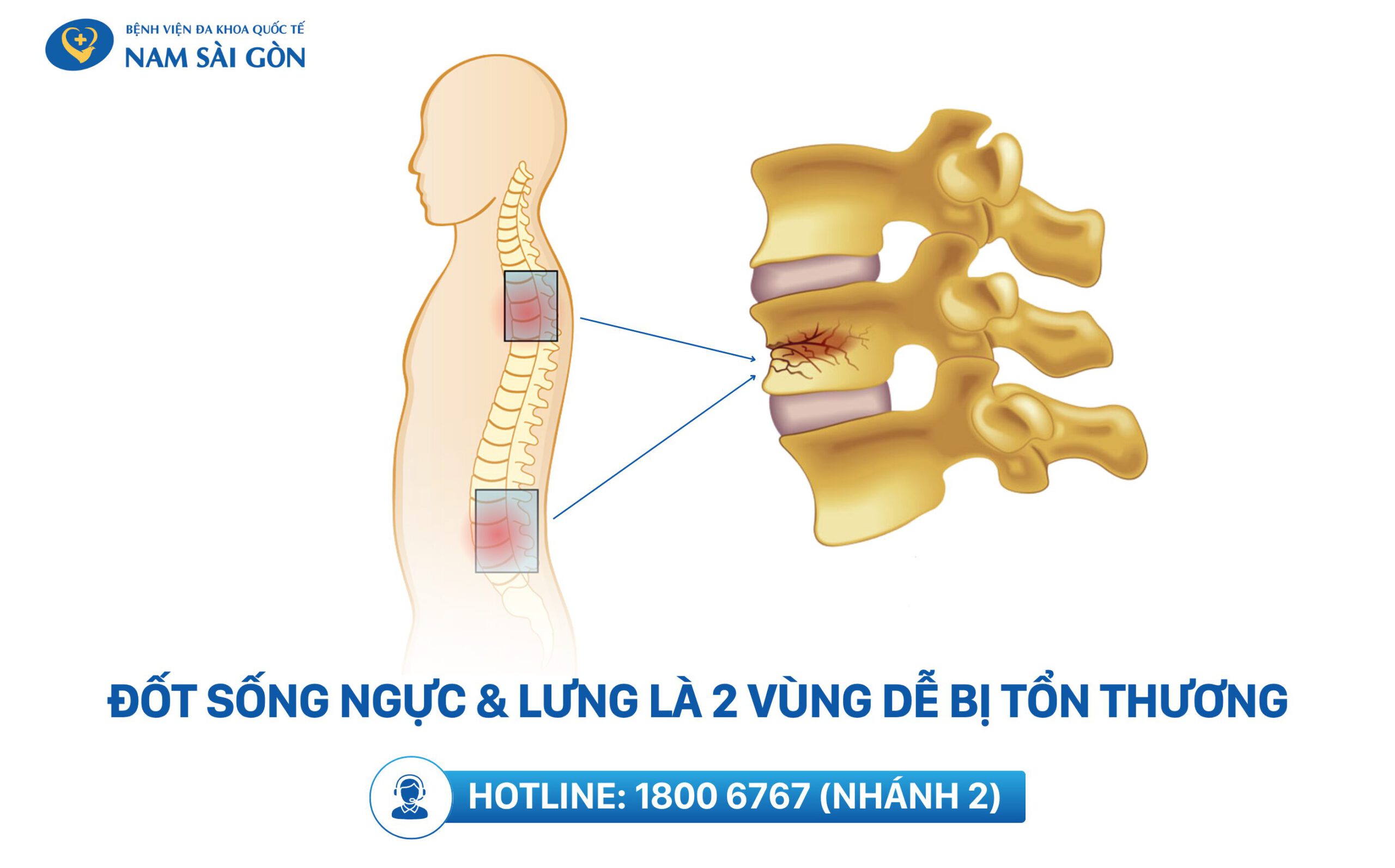 xẹp đốt sống vị trí nào