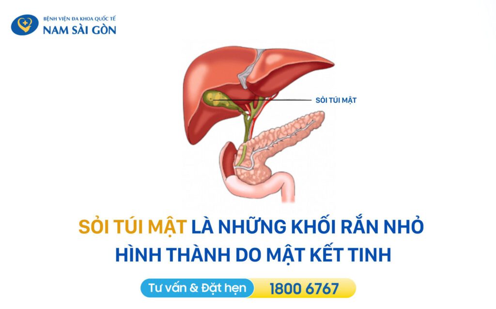 Sỏi túi mật là gì