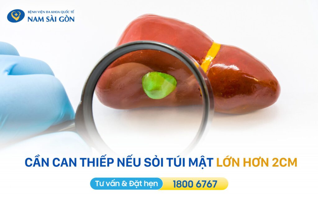 cách trị sỏi túi mật
