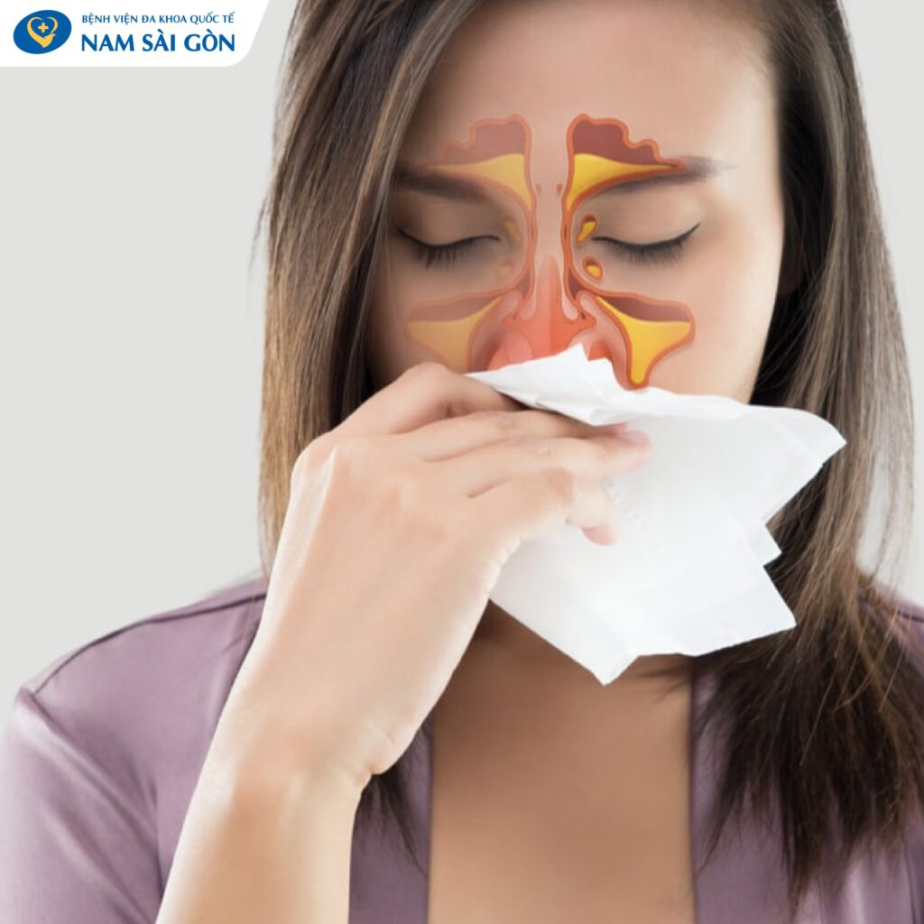 Dấu hiệu của bệnh viêm xoang bướm