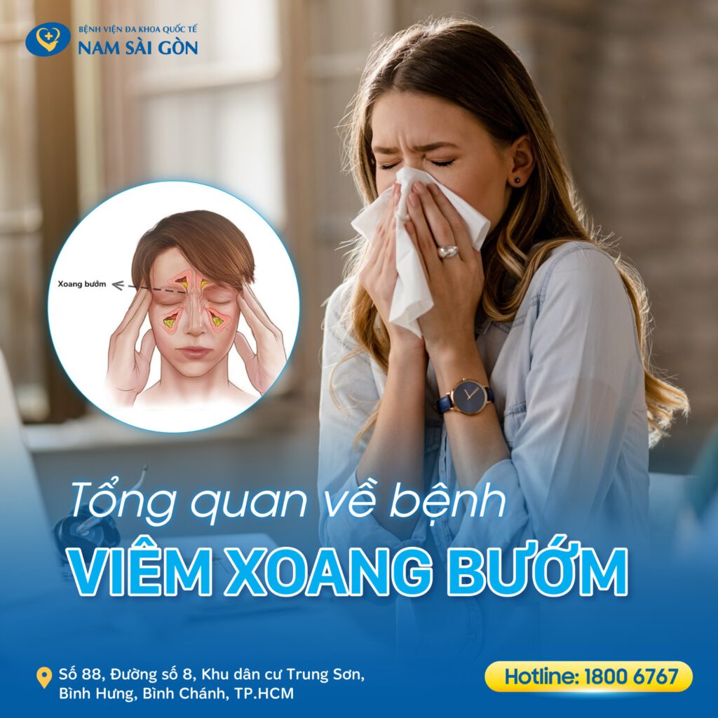 Viêm xoang bướm là gì