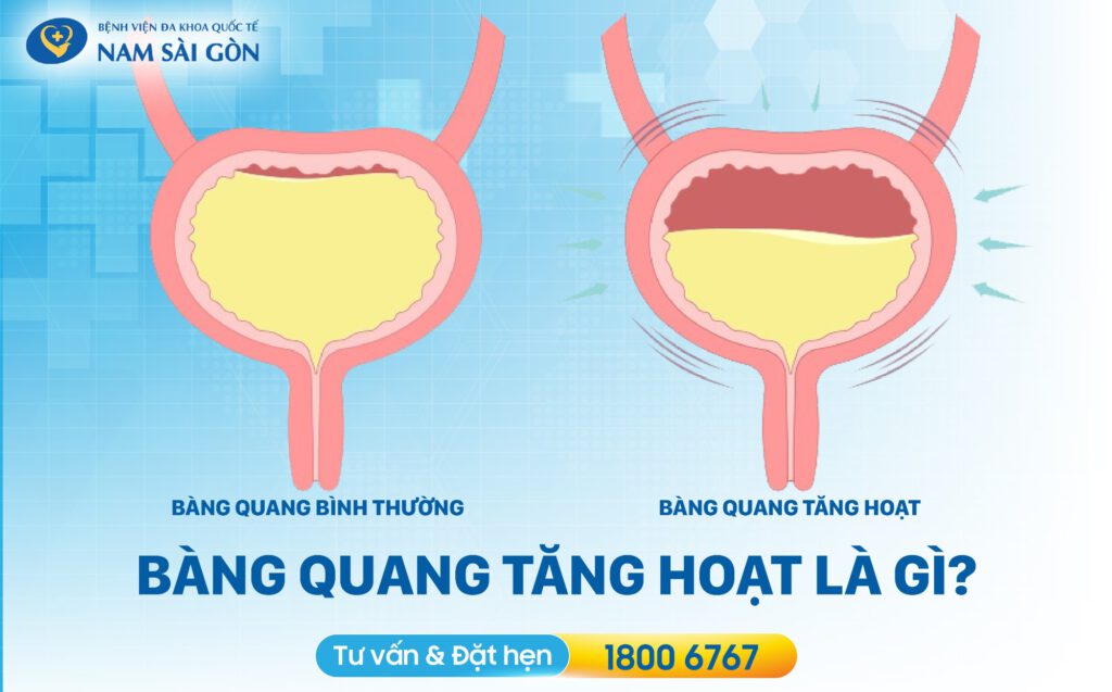 bàng quang tăng hoạt là gì
