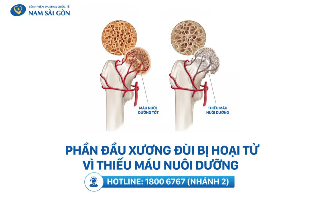 Hoại tử chỏm xương đùi là gì