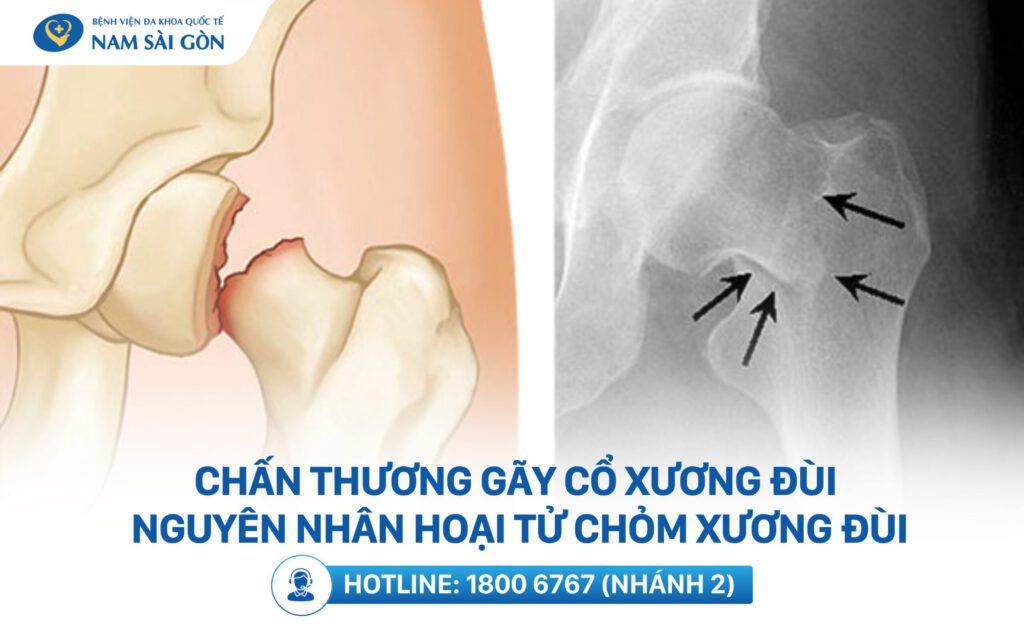 hoại tử khớp háng