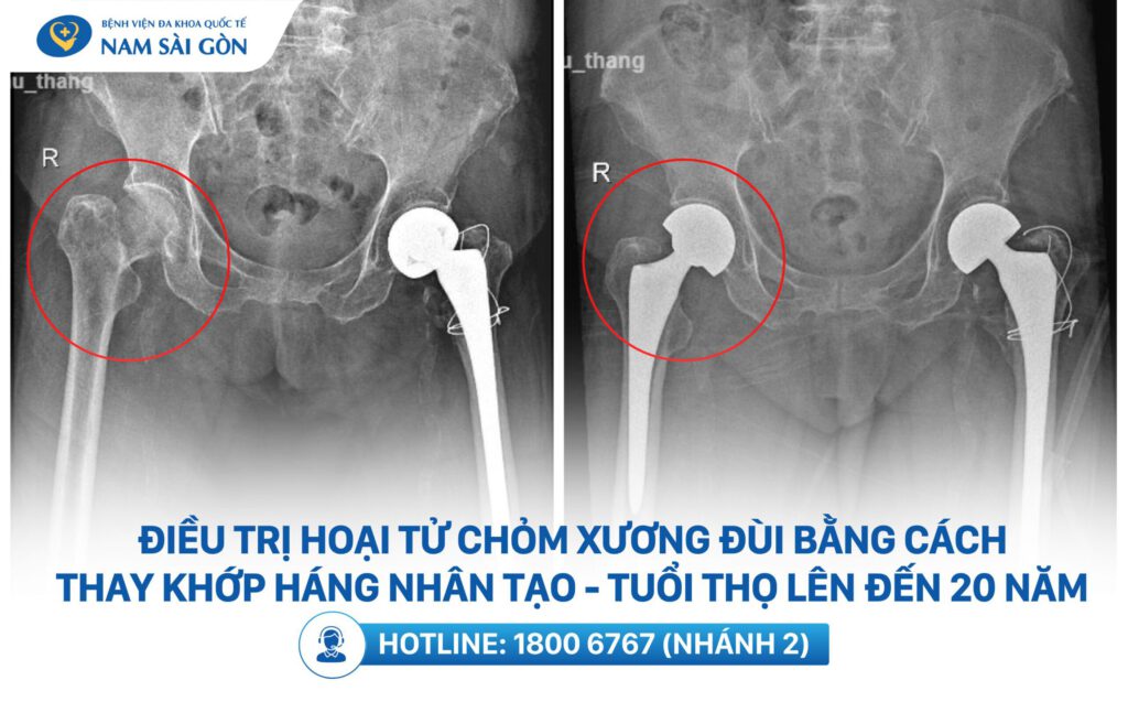điều trị hoại tử chỏm xương đùi