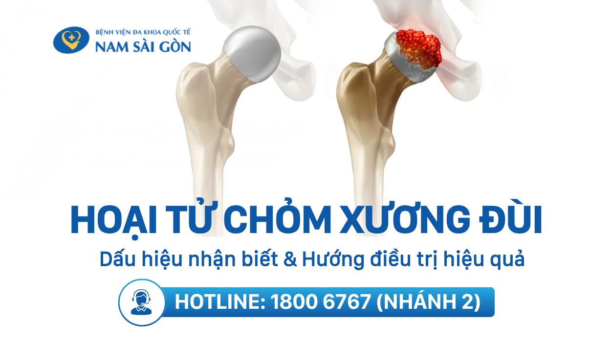 HOẠI TỬ CHỎM XƯƠNG ĐÙI: NGUYÊN NHÂN, DẤU HIỆU, CHUẨN ĐOÁN, ĐIỀU TRỊ