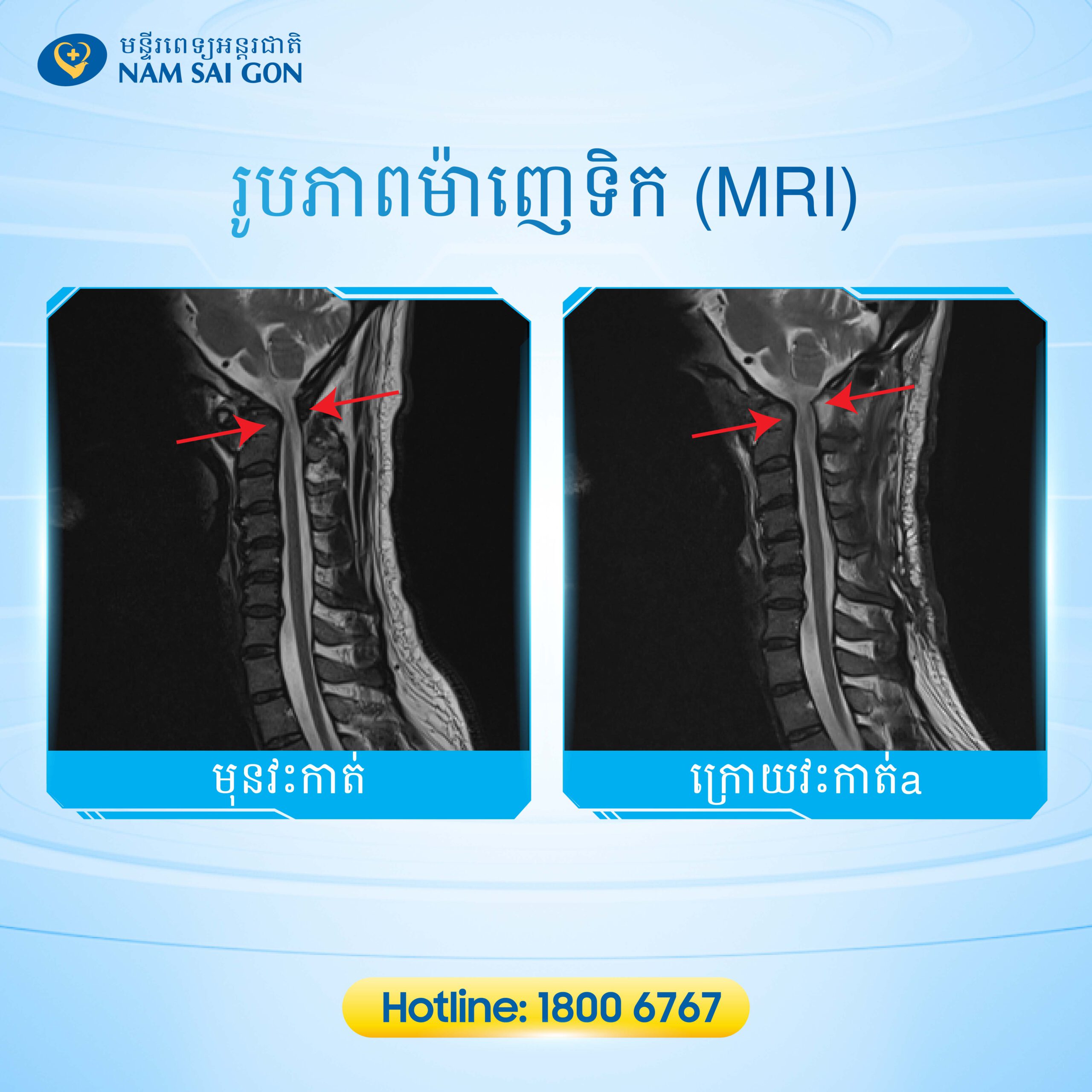 ការរងរបួសឆ្អឹងក - អ្នកជំងឺប្រឈមនឹងហានិភ័យនៃពិការភាពអចិន្រ្តៃយ៍ 4 535 Post CHAN THUONG COT SONG CO Bac Tuan 07 1