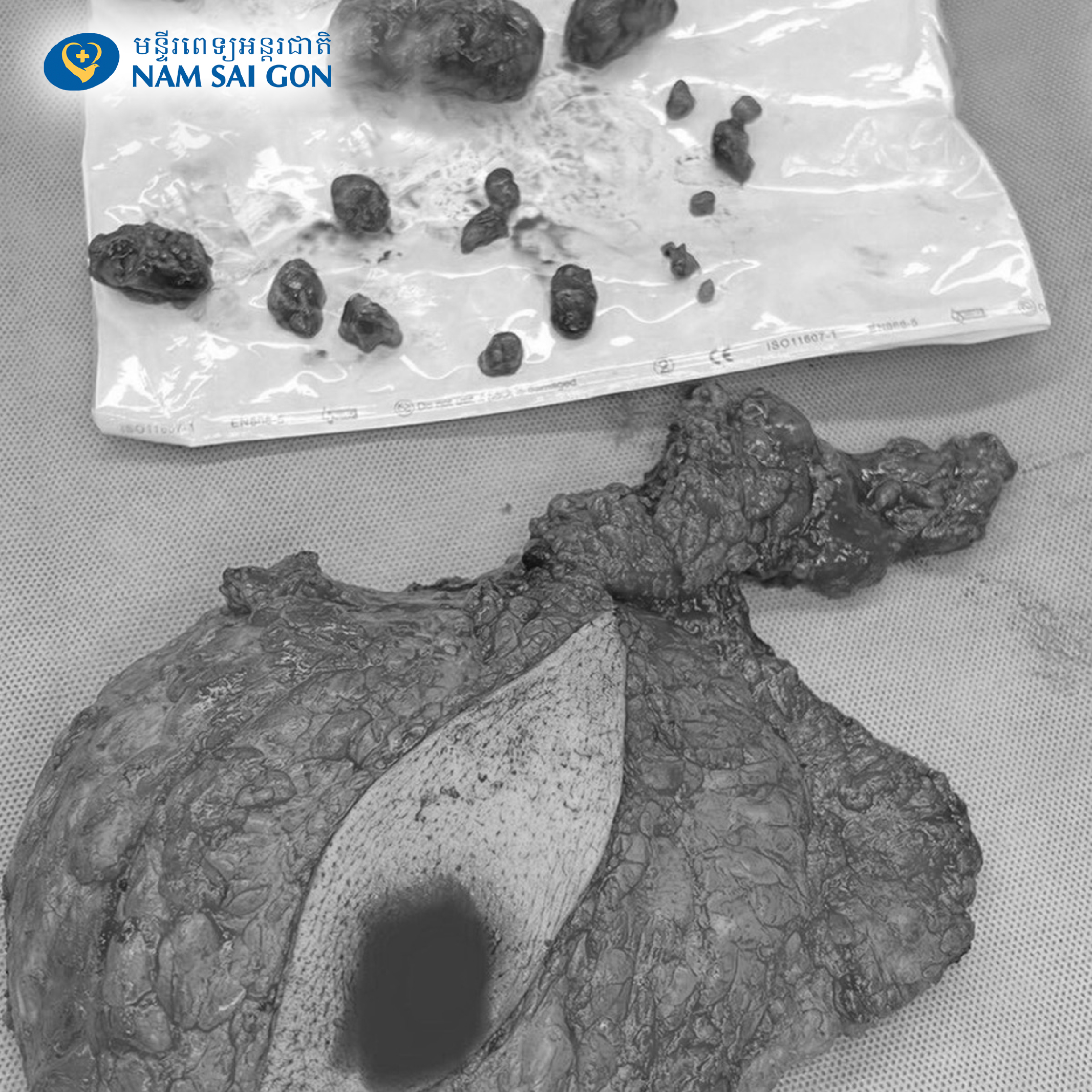 វះកាត់សម្រាប់អ្នកជំងឺដែលមានជំងឺមហារីកសុដន់ដោយមេតាស្តាទិក 5 Bai 15 KHMER Banner 1 copy 2