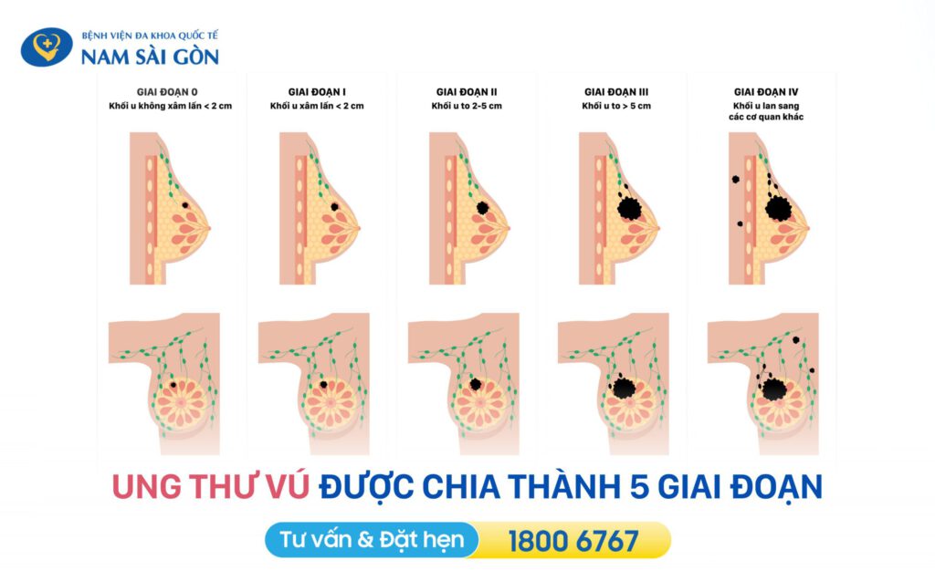 các giai đoạn ung thư vú