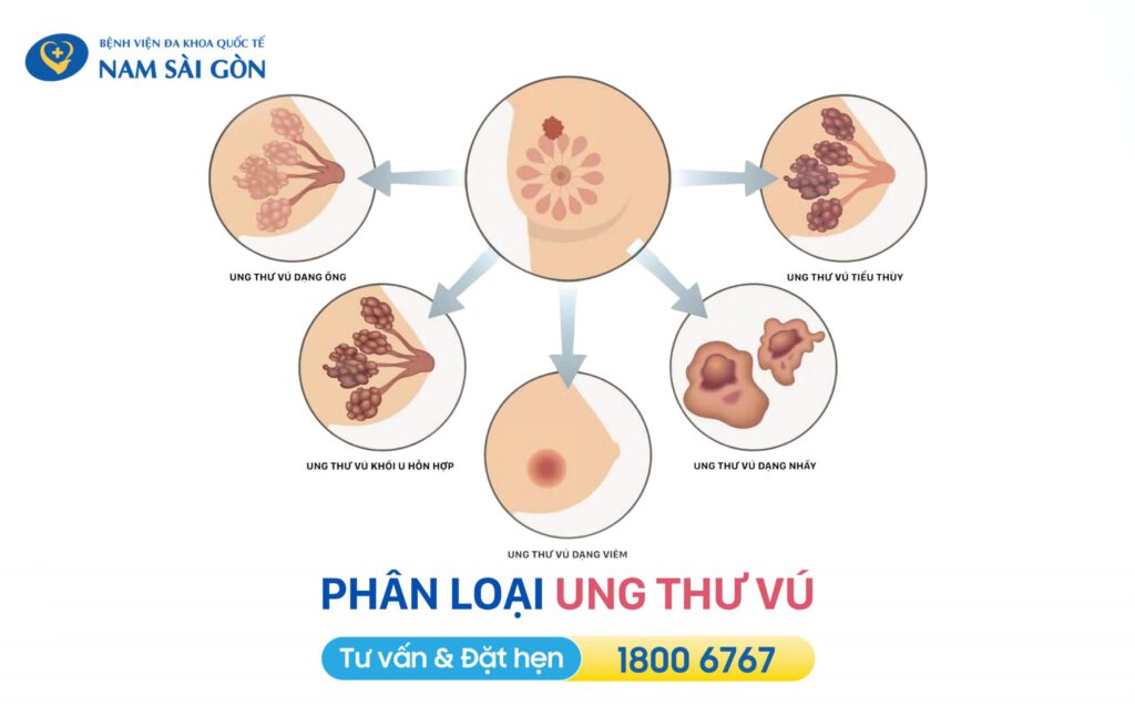các loại ung thư vú