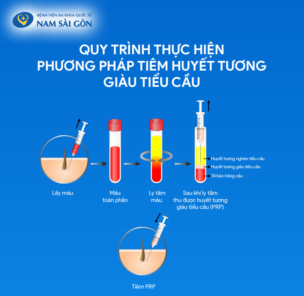 phương pháp tiêm huyết tương giàu tiểu cầu
