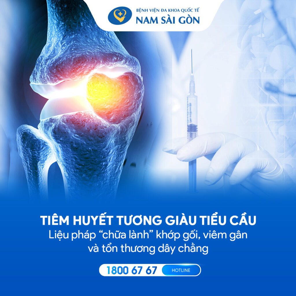 tiêm huyết tương giàu tiểu cầu