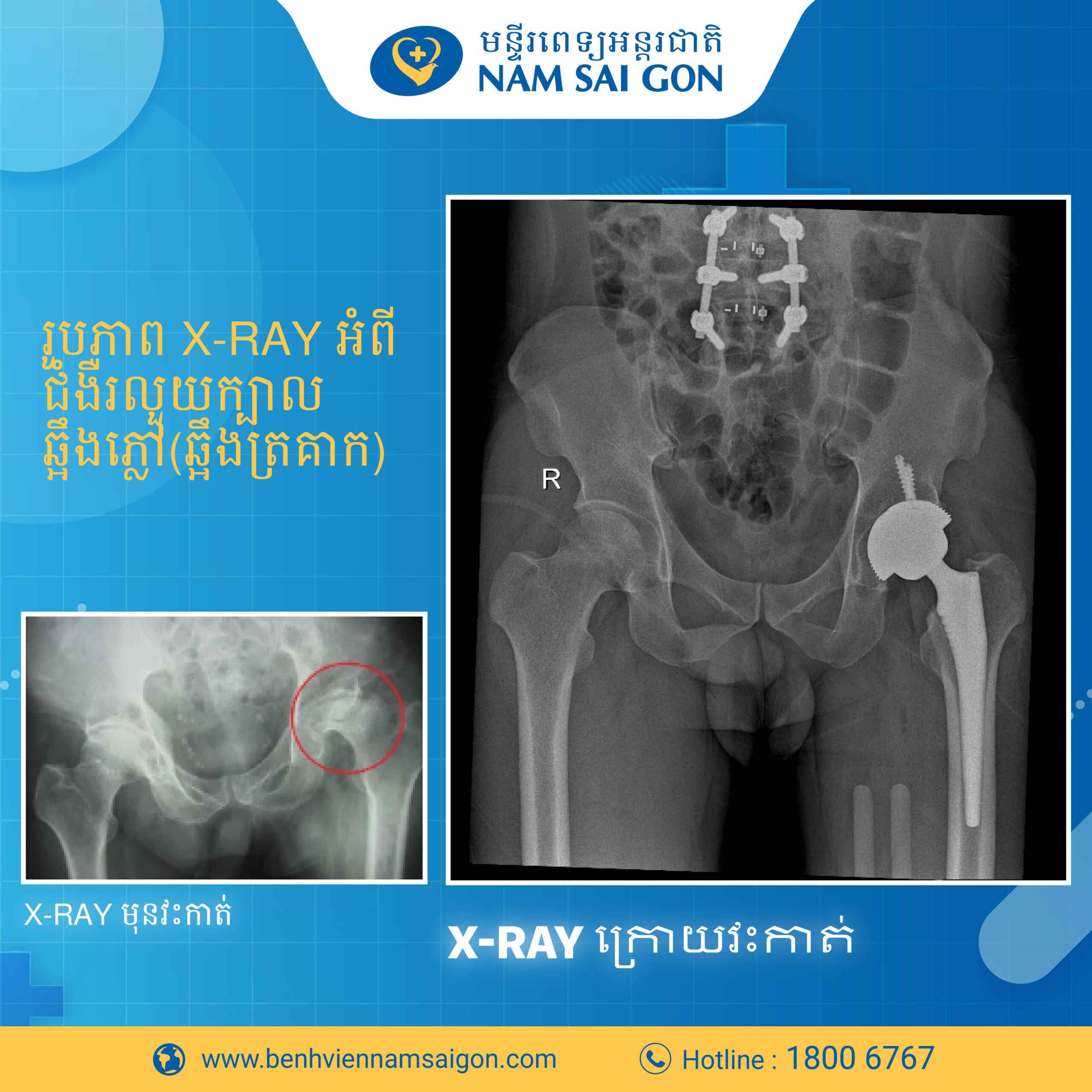 រលួយក្បាលឆ្អឹងភ្លៅ(ឆ្អឹងក្បាលត្រគាក) – ជំងឺគ្រោះថ្នាក់ងាយរោគវិនិច្ឆ័យខុស 8 Banner 03