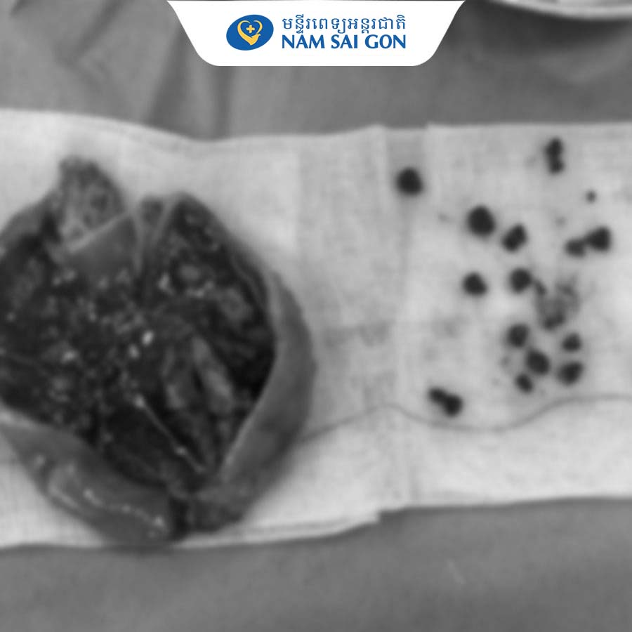 យកក្រួសចំនួន15គ្រាប់ចេញពីថង់ប្រមាត់ជួនលោកយាយអាយុ84ឆ្នាំម្នាក់ 7 framehinh2 1