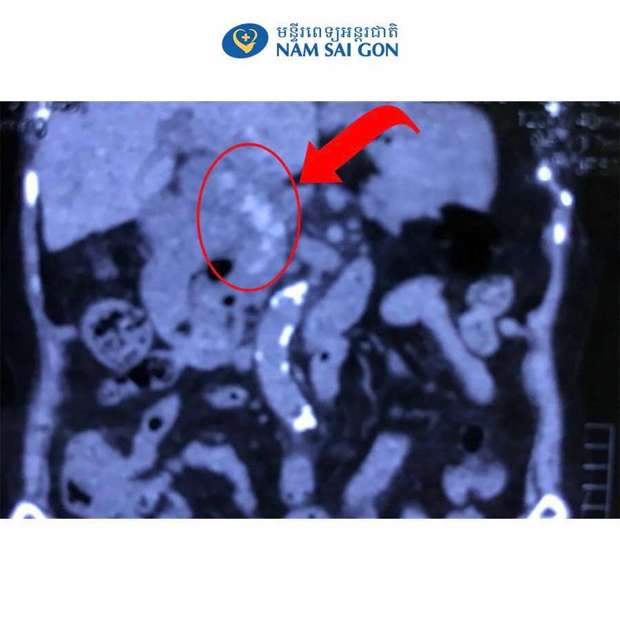 យកក្រួសចំនួន15គ្រាប់ចេញពីថង់ប្រមាត់ជួនលោកយាយអាយុ84ឆ្នាំម្នាក់ 8 framehinh 1 1
