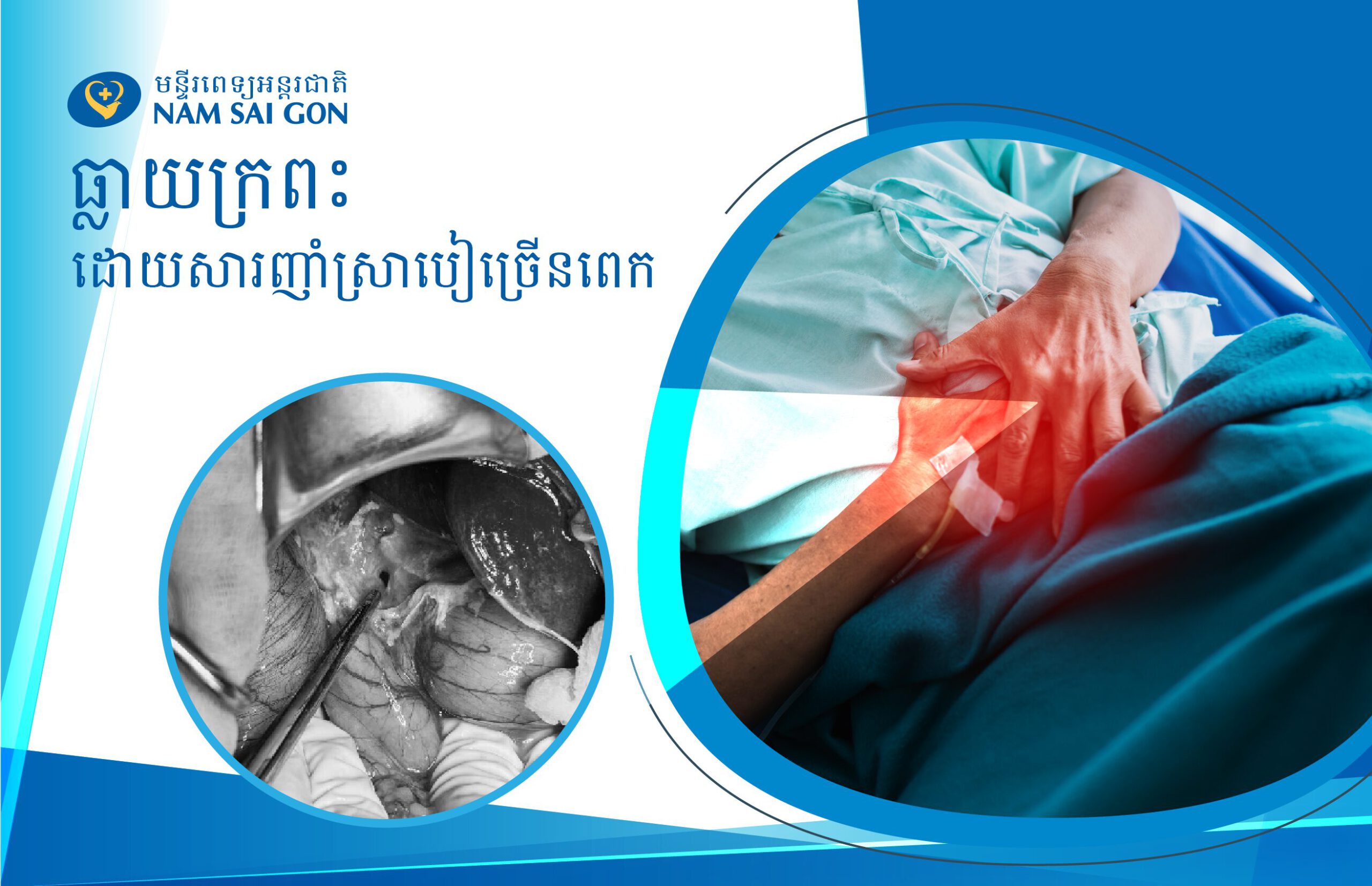 ជំងឺឆ្លាយក្រពះដោយសារញាំស្រាបៀរច្រើន