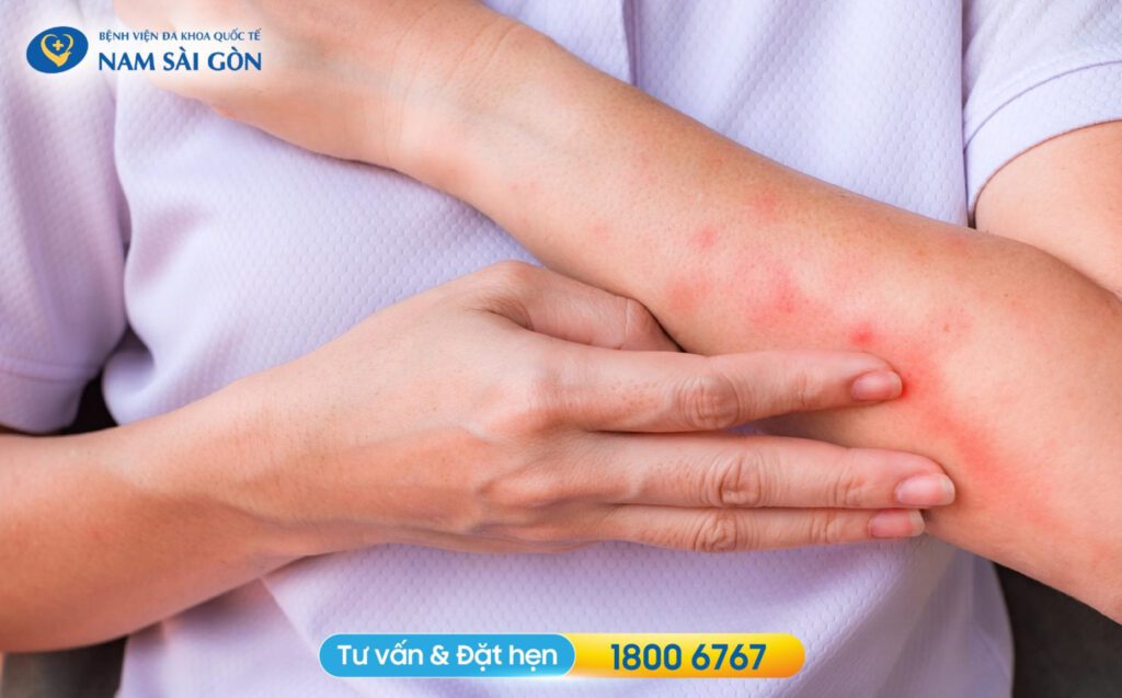 dấu hiệu nhận biết viêm da cơ địa