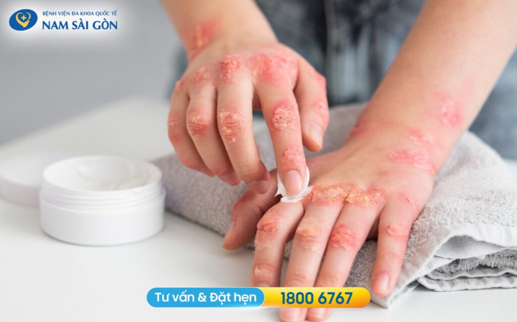 dấu hiệu viêm da cơ địa