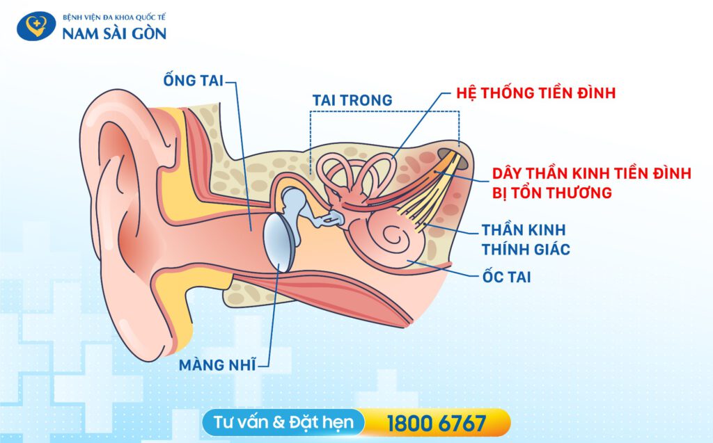 bị tiền đình là gì