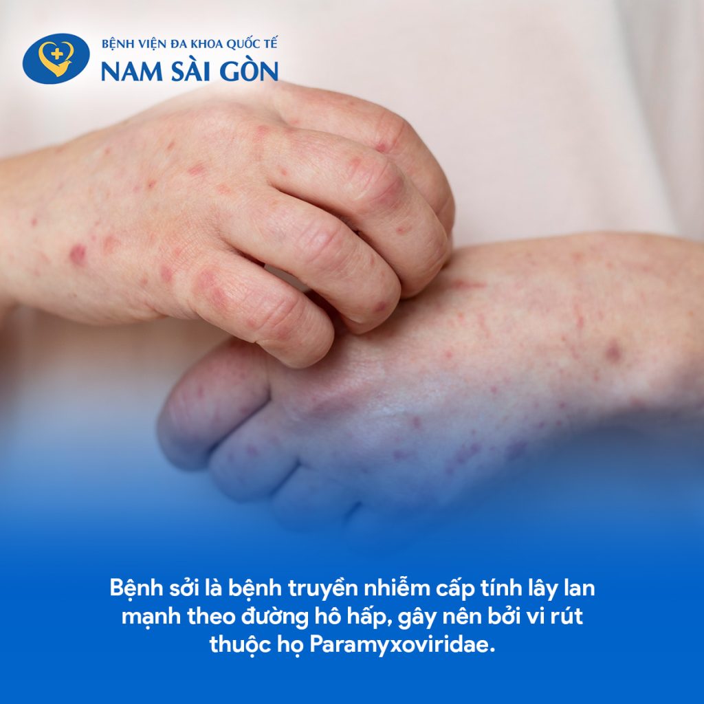 BỆNH SỞI - NGUYÊN NHÂN, TRIỆU CHỨNG, CHẨN ĐOÁN VÀ CÁCH ĐIỀU TRỊ 2 1 1