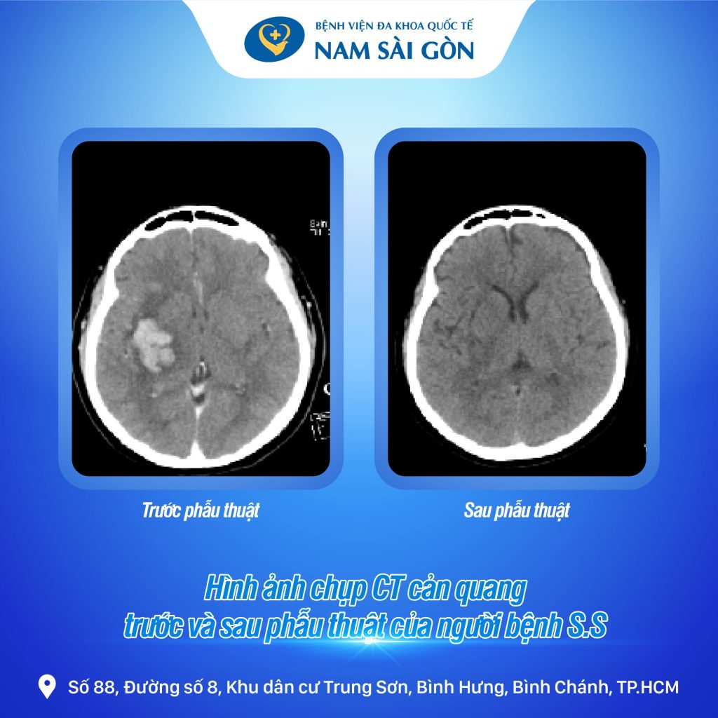 2 TRƯỜNG HỢP XUẤT HUYẾT NÃO ĐƯỢC ĐIỀU TRỊ MÀ KHÔNG CẦN MỞ HỘP SỌ LỚN 3 Hình Ảnh CT Cản Quang Trước Và Sau Phẫu Thuật Của Người Bệnh