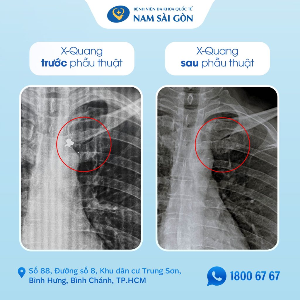 SUCCESSFUL SURGERY TO REMOVE A BULLET FRAGMENT PIERCING THROUGH THE CHEST AND LODGED IN THE BACK 3 14 02