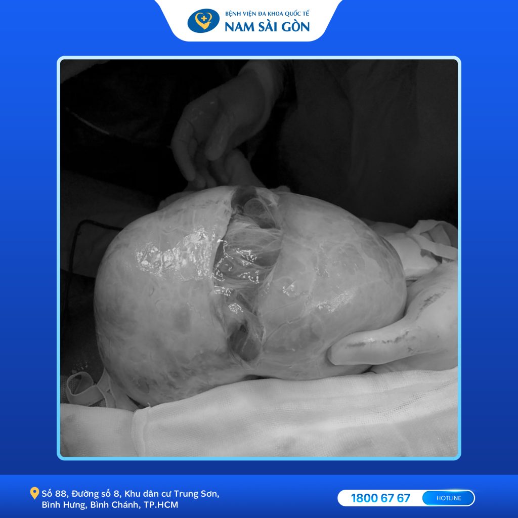 REMOVING MASSIVE OVARIAN TUMOR METASTASIZED FROM ABDOMINAL STRUCTURES 3 1689 hinhwweb 1