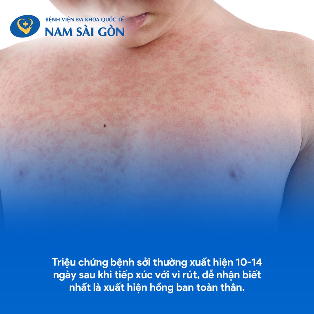 BỆNH SỞI - NGUYÊN NHÂN, TRIỆU CHỨNG, CHẨN ĐOÁN VÀ CÁCH ĐIỀU TRỊ 3 2 4