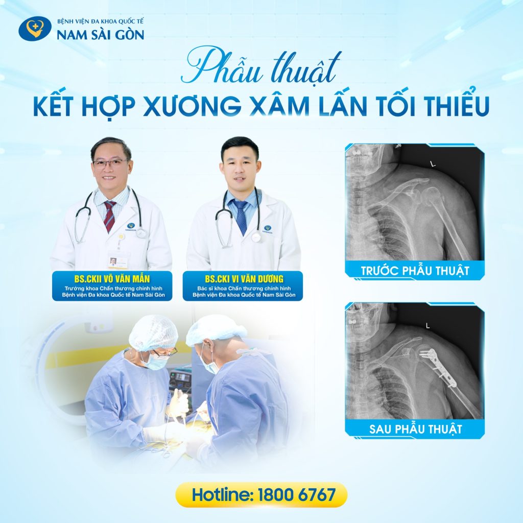 PHẪU THUẬT KẾT HỢP XƯƠNG XÂM LẤN TỐI THIỂU - ĐIỀU TRỊ GÃY CỔ PHẪU THUẬT XƯƠNG CÁNH TAY 2 516 phau thuat xuong canh tay bac man bac duong 01 3 1