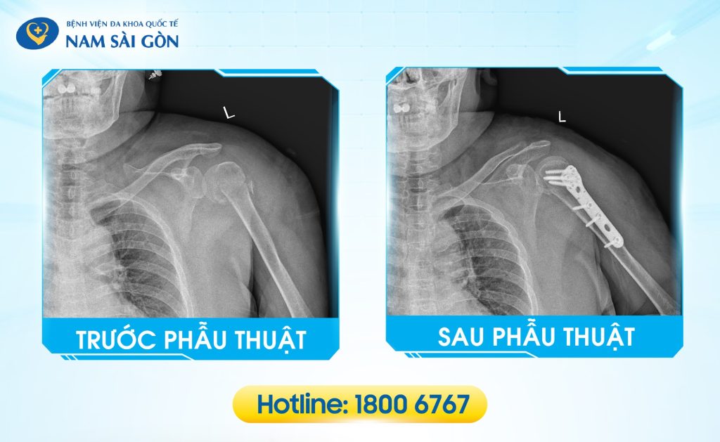 PHẪU THUẬT KẾT HỢP XƯƠNG XÂM LẤN TỐI THIỂU - ĐIỀU TRỊ GÃY CỔ PHẪU THUẬT XƯƠNG CÁNH TAY 4 516 phau thuat xuong canh tay bac man bac duong 04 2