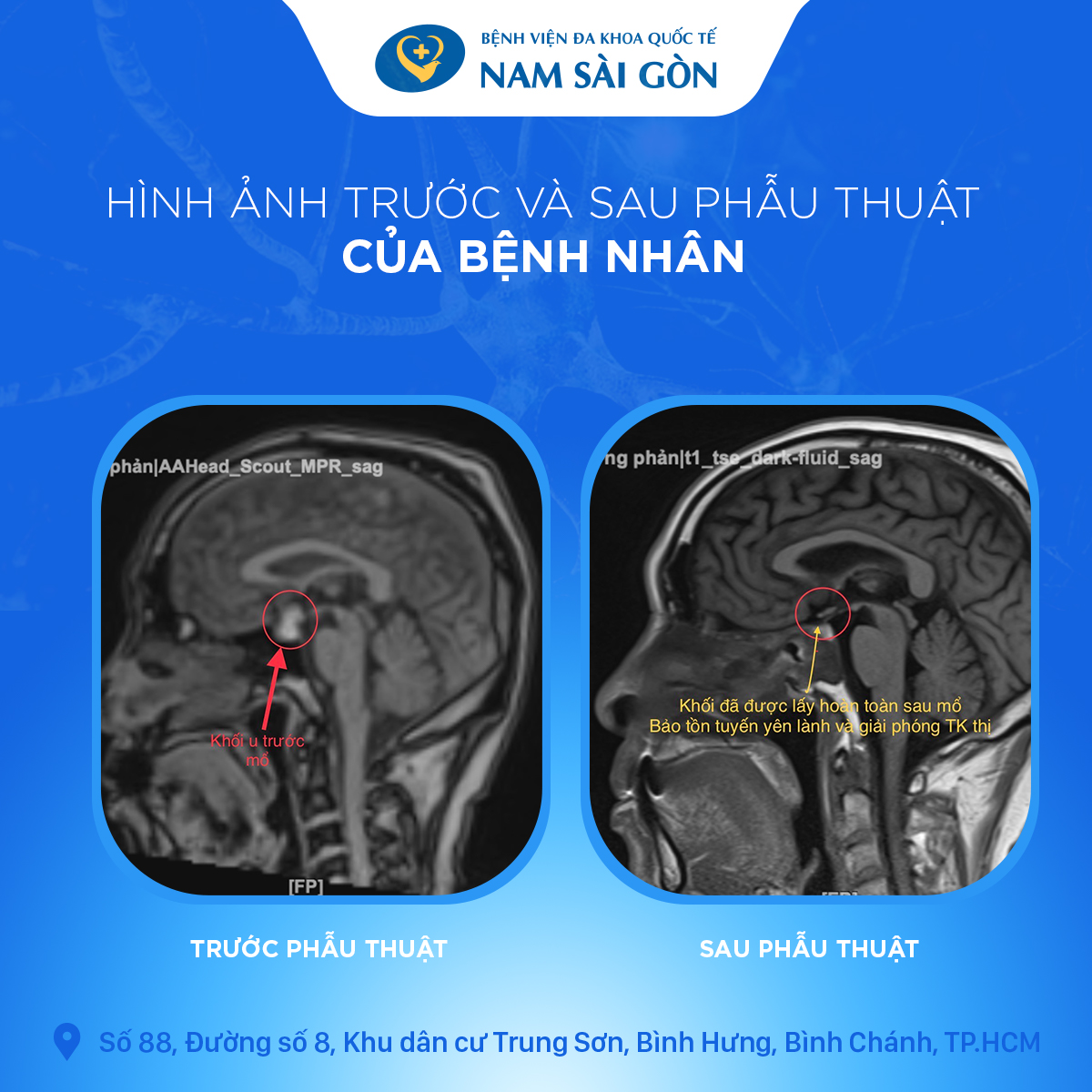 artboard_2_copy_2_1-1 Trước Và Sau Phẫu Thuật Của Bệnh Nhân Bị U Tuyến Uyên