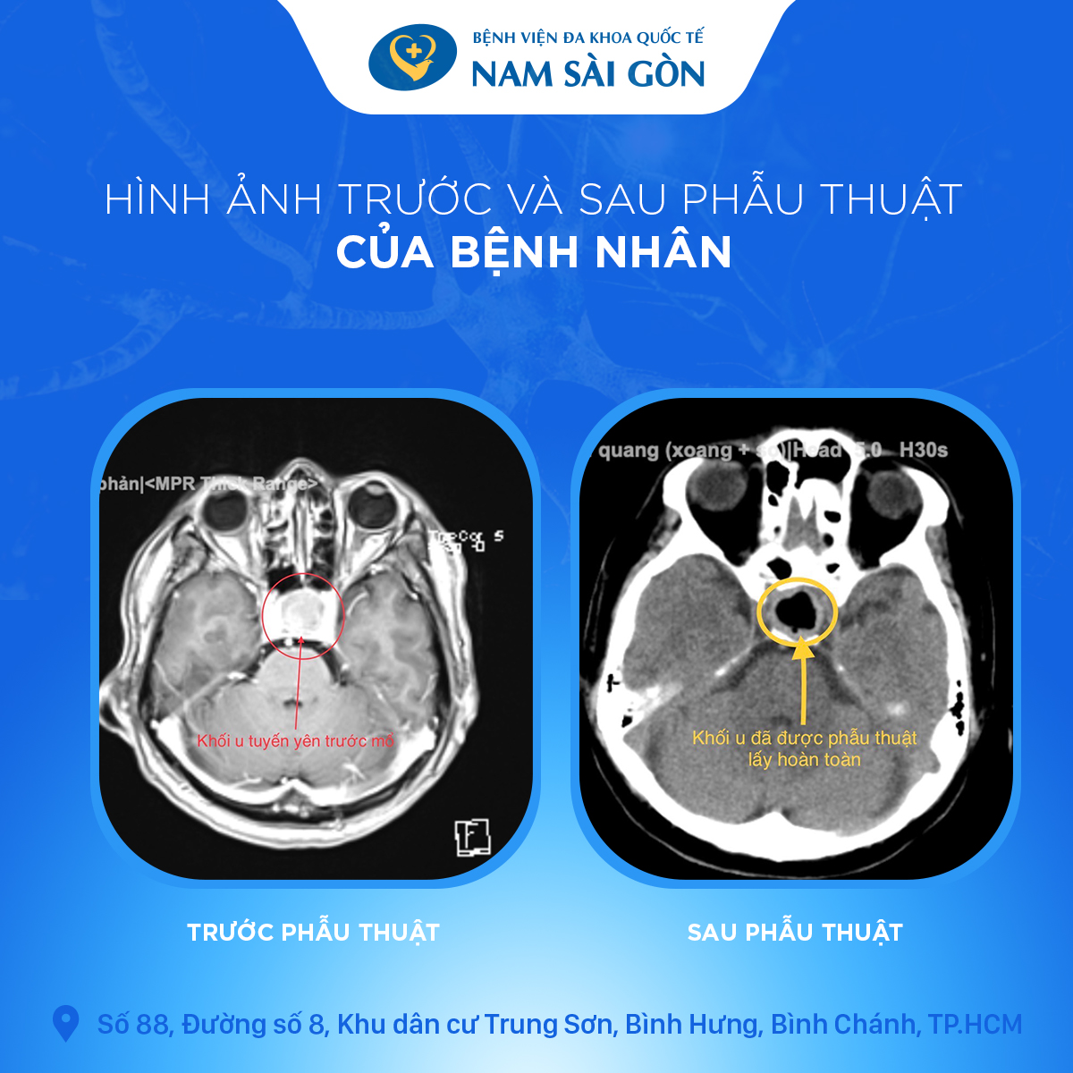 artboard_2_copy_3-1 Trước Và Sau Phẫu Thuật Của Bệnh Nhân U Tuyến Uyên