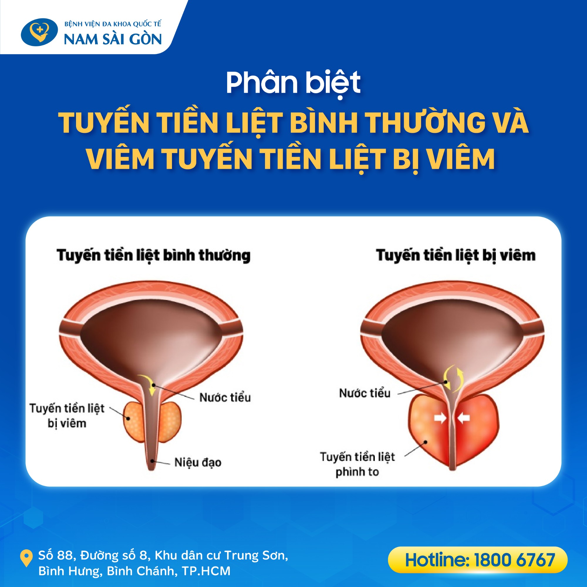 dau hieu viem tuyen tien liet 03