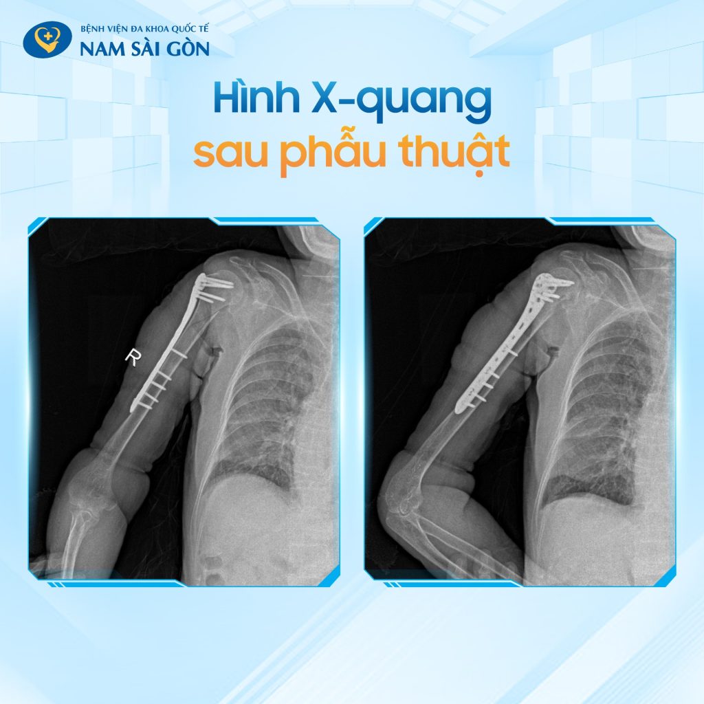 PHẪU THUẬT KẾT HỢP XƯƠNG CÁNH TAY CHO CỤ BÀ HƠN 100 TUỔI 4 ket hop xuong canh tay 03