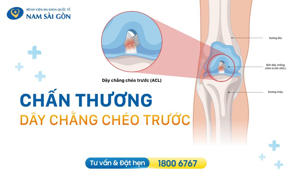 minh hoa dut day chang cheo