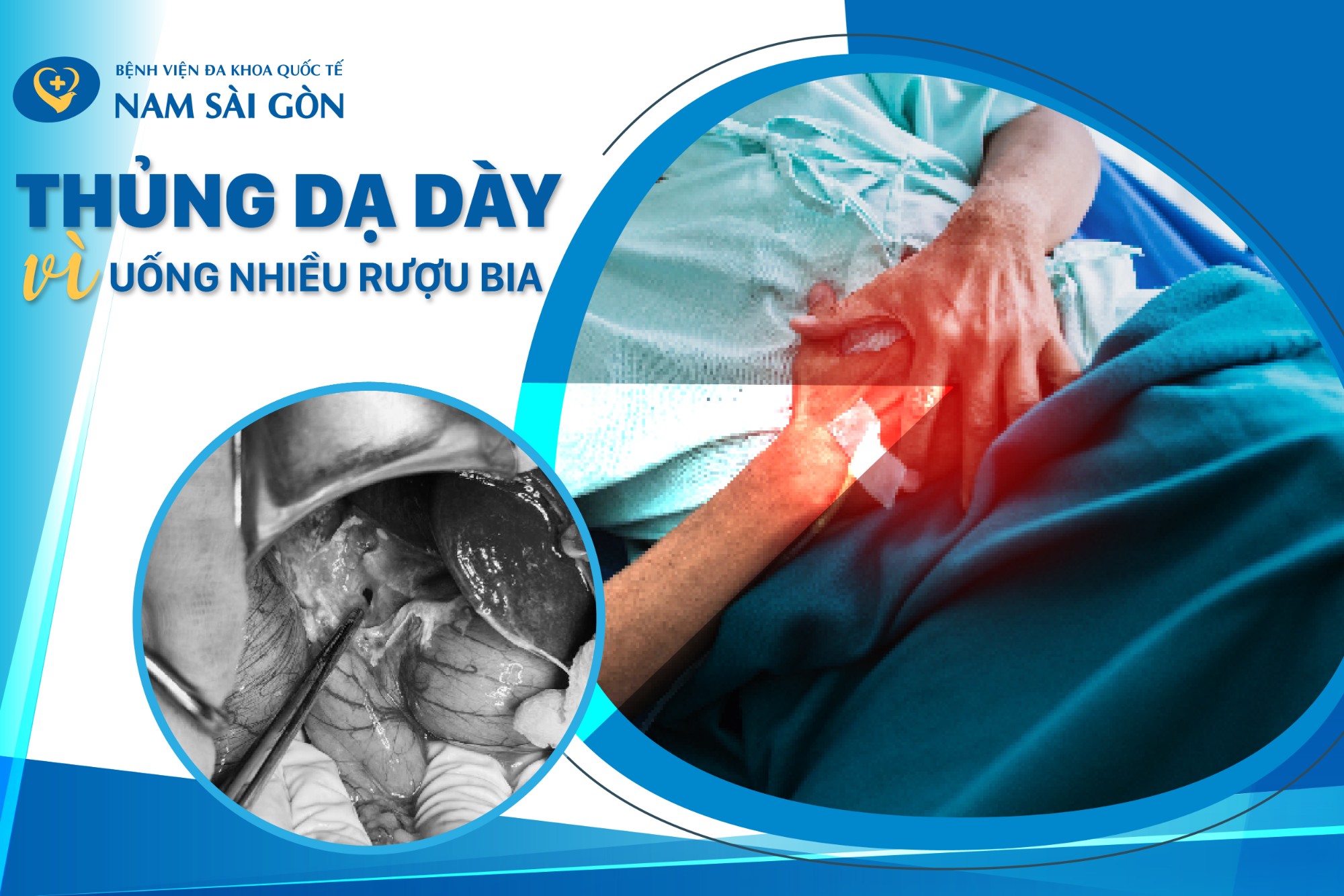 THỦNG DẠ DÀY VÌ UỐNG NHIỀU RƯỢU BIA