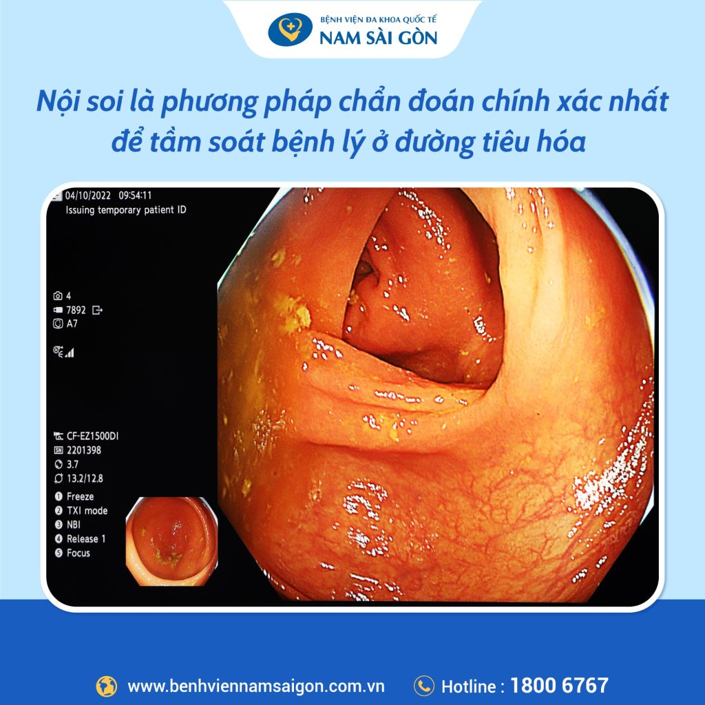 post may noi soi cv1500 02 1