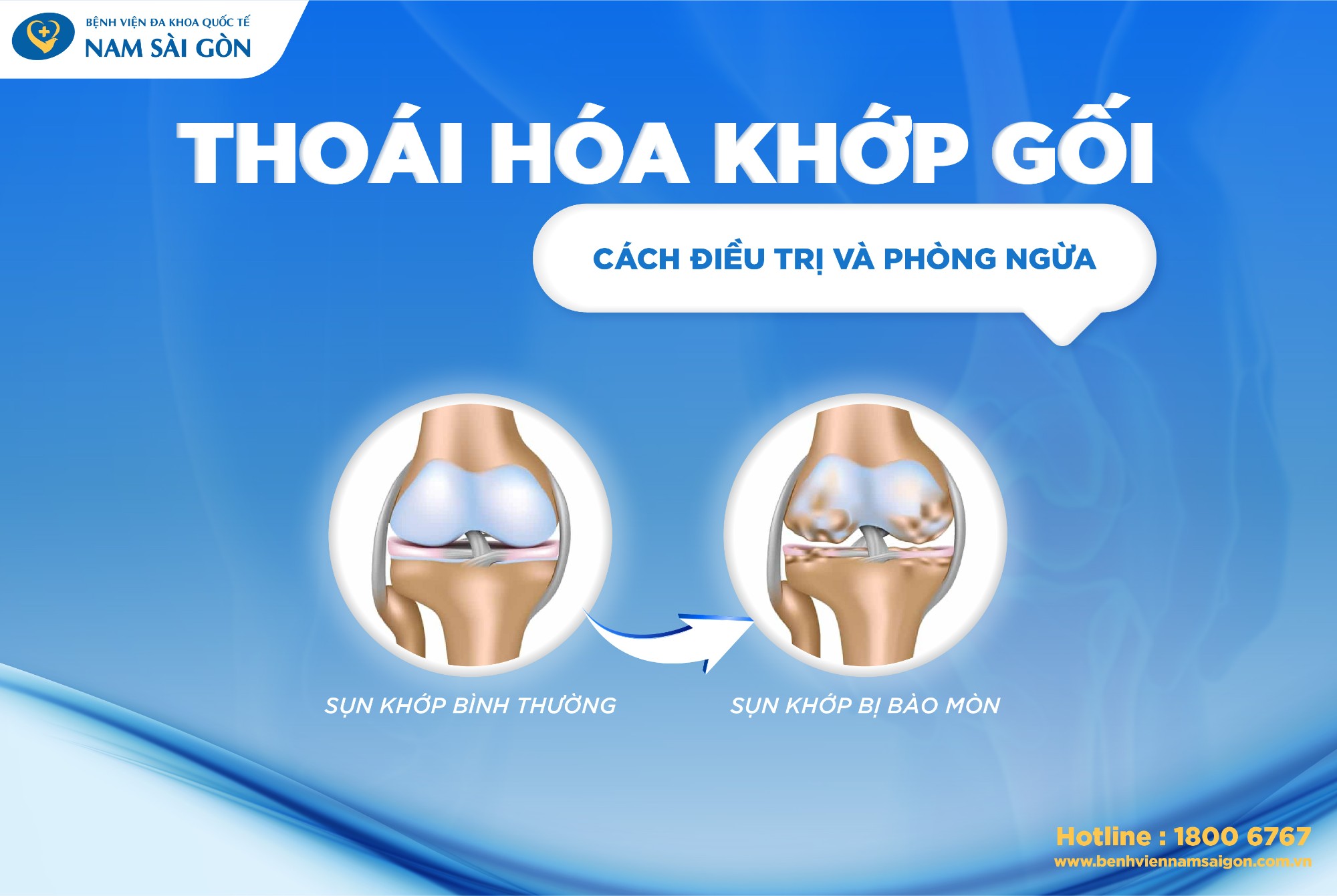 post thoai hoa khop 01 1